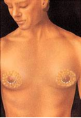 Male Breast Gynecomastia
