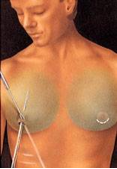 Male Breast Gynecomastia